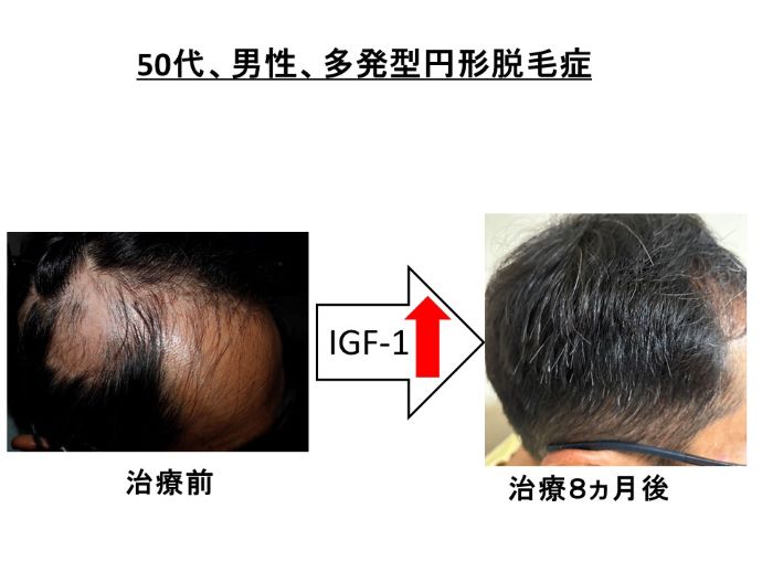 円形脱毛症　病院
